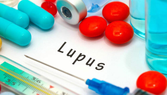 Common Treatment Options For Controlling Lupus