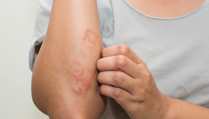 Common Types and Treatments of Eczematous Dermatitis