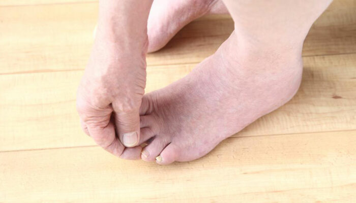 Diabetic Neuropathy &#8211; Risk Factors, Symptoms, and Treatments