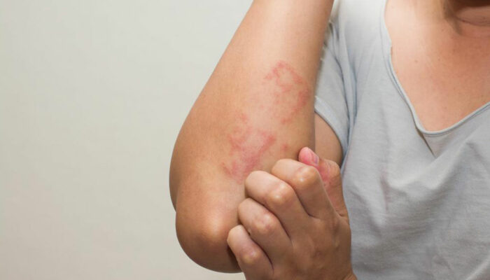 Dietary Changes and Tips to Cure Shingles Rash