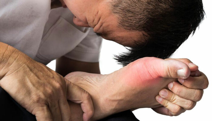 Different Treatment Plans for Gout Pain Relief and Prevention of Gout Attacks