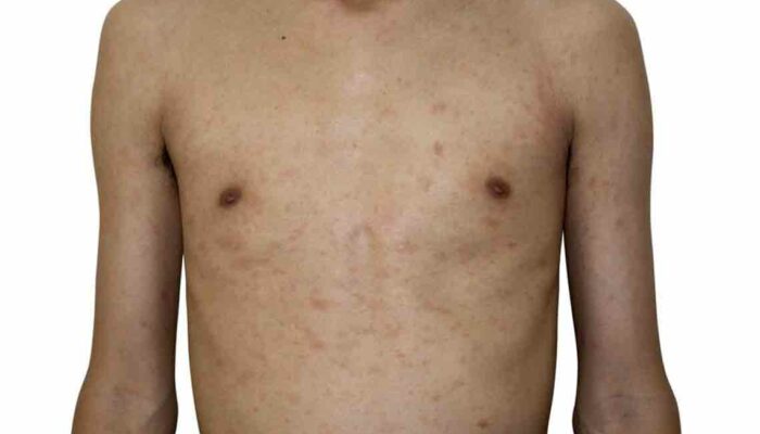 Different Types of Pityriasis Rosea Treatments