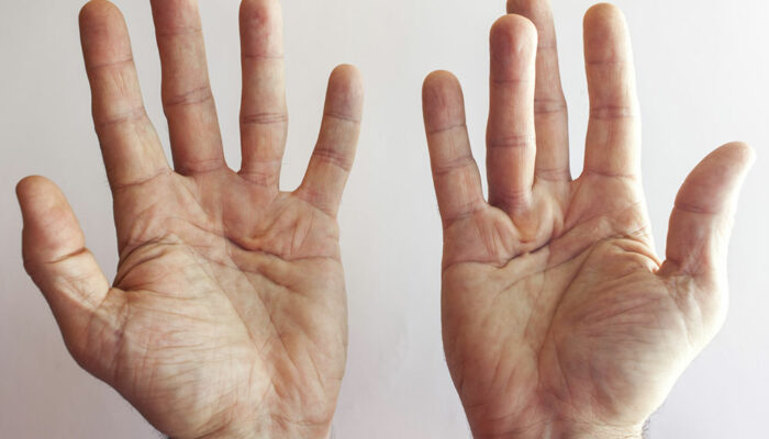 Dupuytren’s Contracture &#8211; Its Symptoms and Causes