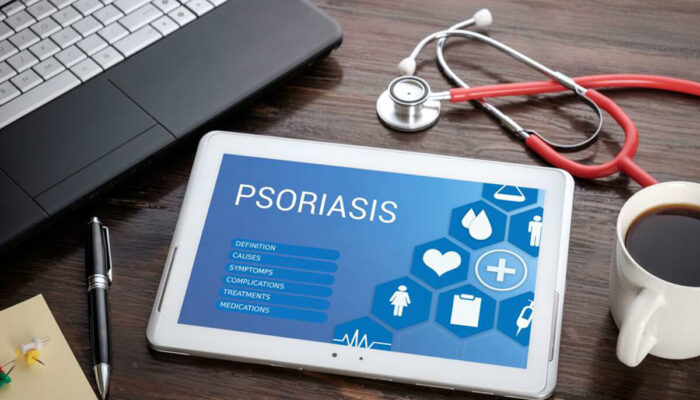 Easy DIY Remedies to Treat Psoriasis Symptoms