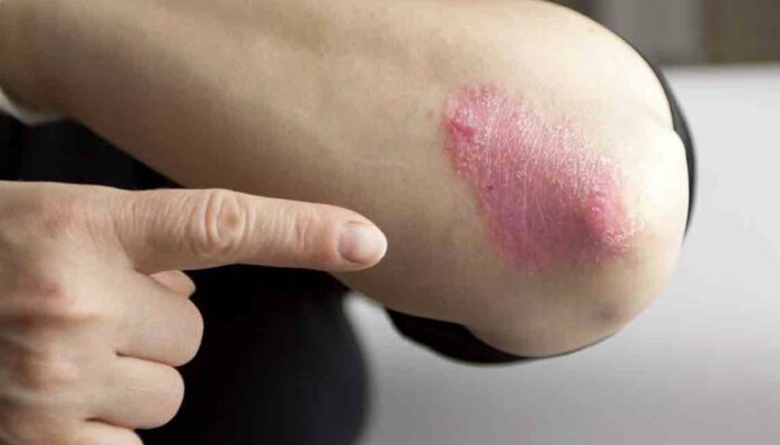 Easy Treatment Options to Cure Psoriasis