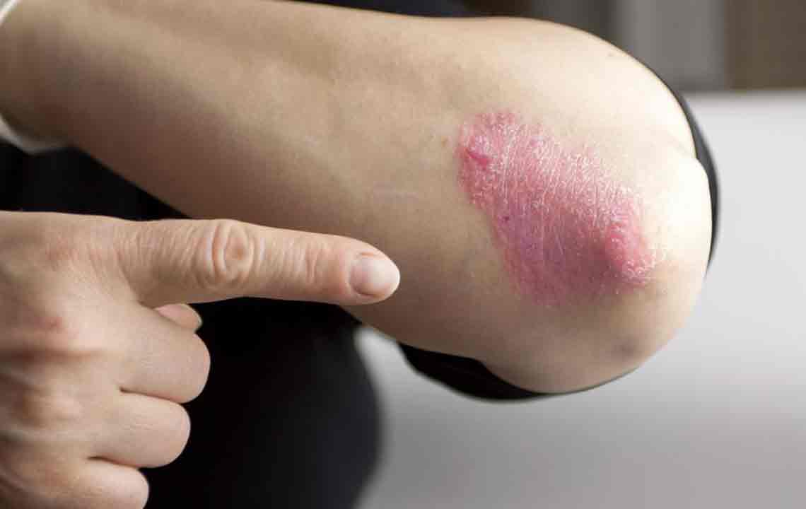 Easy Treatment Options to Cure Psoriasis