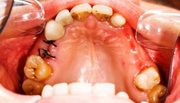 Effective Home Remedies to Treat Cavities