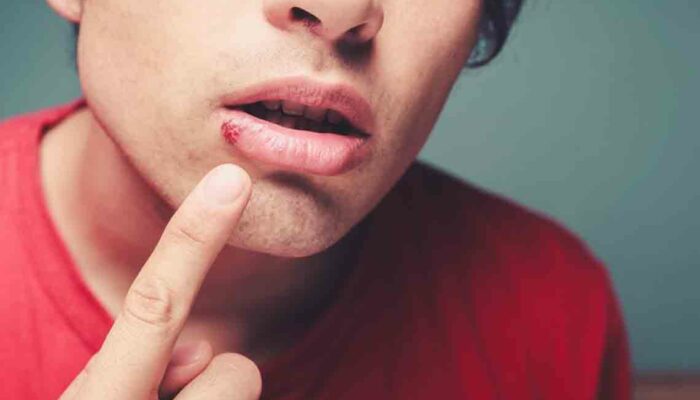 Effective Home Remedies for Treating Cold Sores