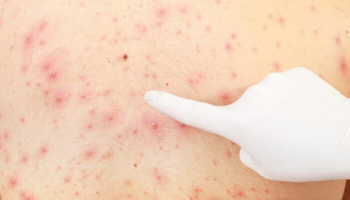 Effective Remedies for Treating Skin Rashes