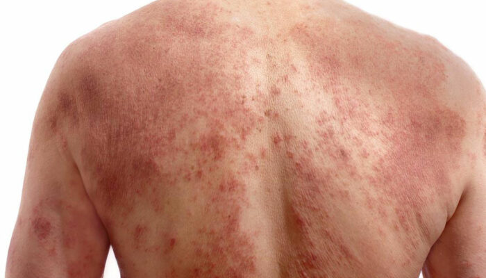 Effective Shingles Nerve Pain Treament