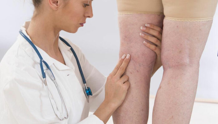 Effective Treatment for Varicose Veins