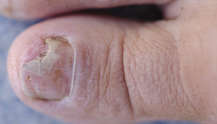 Effective Ways to Treat Toe Fungus