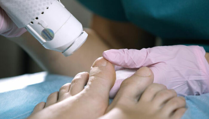 Essential Facts about Nail Fungus Cure