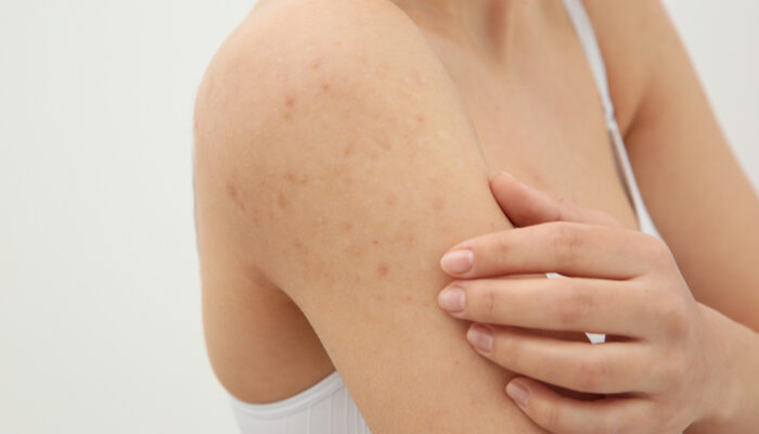 Everything You Need To Know About Hiv Skin Rash