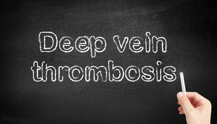 Everything to Know about Deep Vein Thrombosis