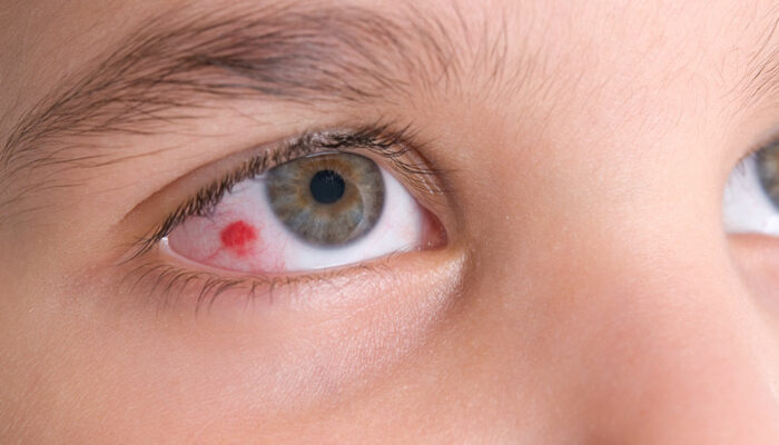 Eye infections &#8211; All you need to know