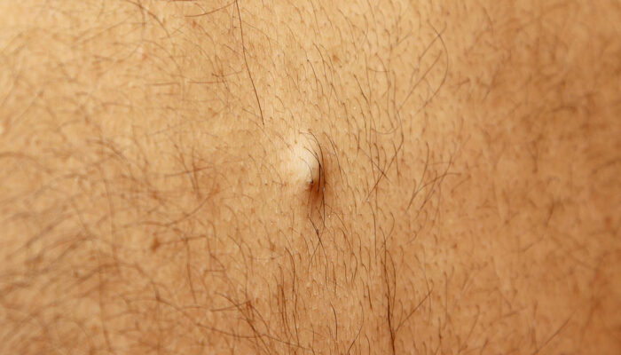 Facts and Signs of Ingrown Hair