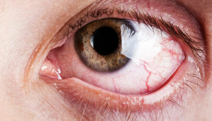 Few Vital Causes and Cure of Chronic Dry Eye