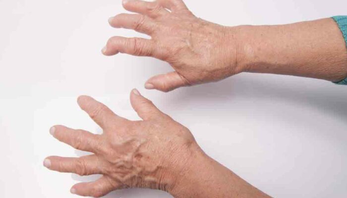 Food Items You Should Avoid When Suffering from Arthritis