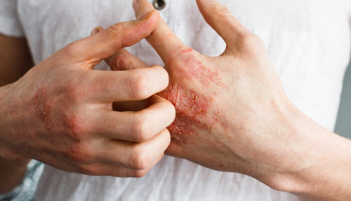 Foods to Eat and Avoid for Patients with Eczema