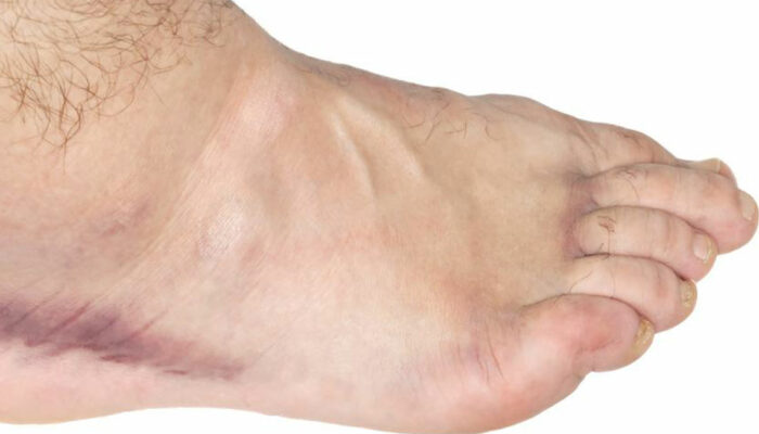 Get Easy Relief from Your Swollen Ankle