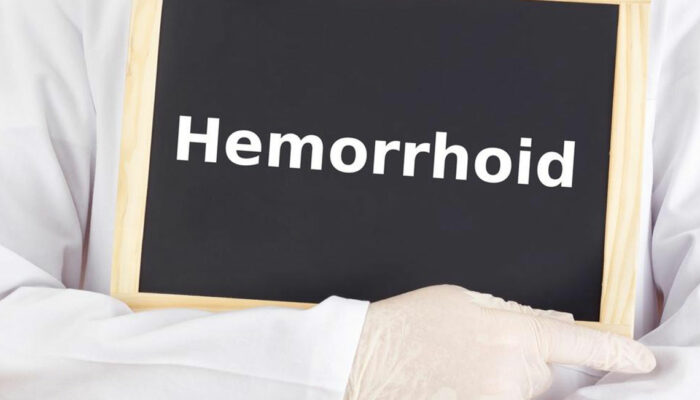 Get Relief with These Effective Hemorrhoids Treatment Options