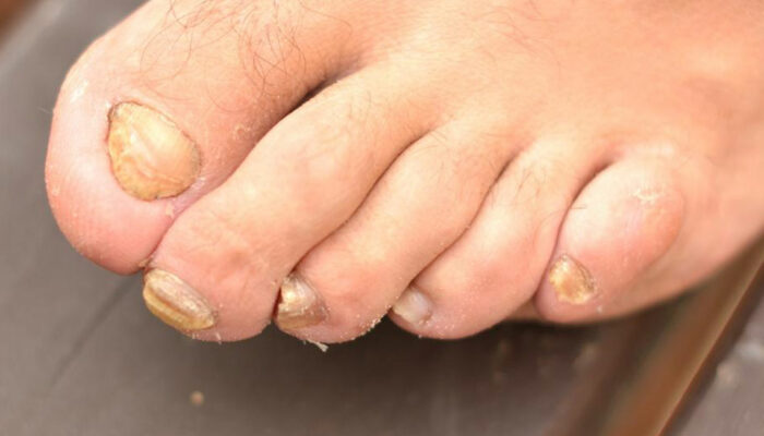 Get Rid of Toenail Fungus Quickly with 6 Home Remedies