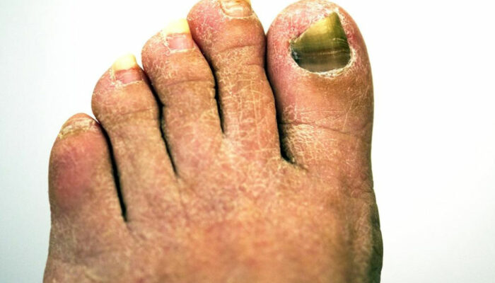 Get Rid of Toenail Fungus With the Right Treatment