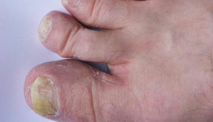 Guide to Treating Toenail Fungus