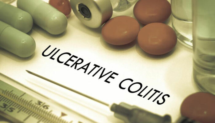 Here Are Some of the Popular Ulcerative Colitis Treatments