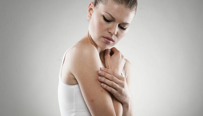 Here Are a Few Things to Know about Eczema Treatments