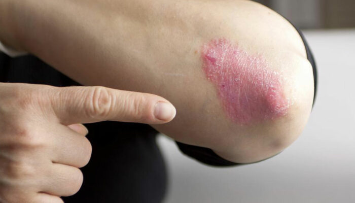 Here Are a Few Things to Know about Psoriasis