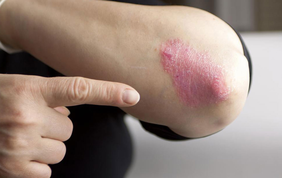 Here Are a Few Things to Know about Psoriasis