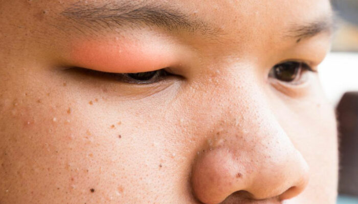 Here&#8217;s How to Get Rid of a Stye With These Simple Steps