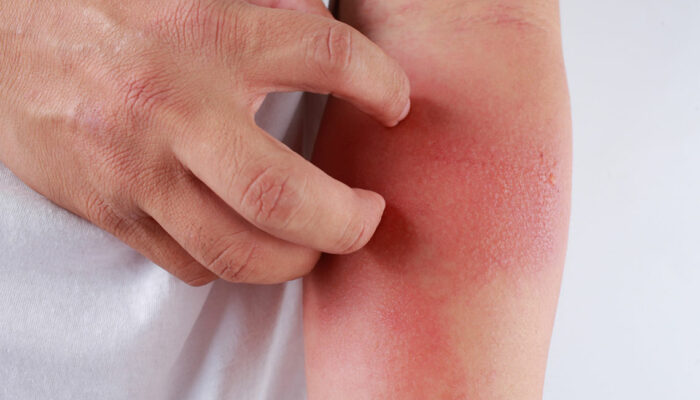 Here&#8217;s How to Identify a Skin Rash