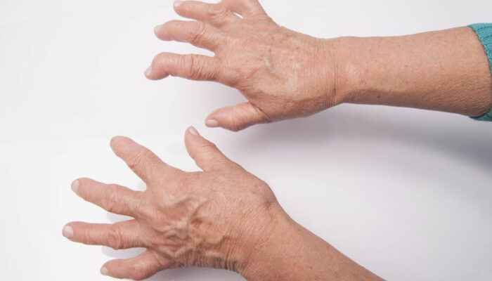 Here&#8217;s What You Need to Know About Rheumatoid Arthritis Symptoms