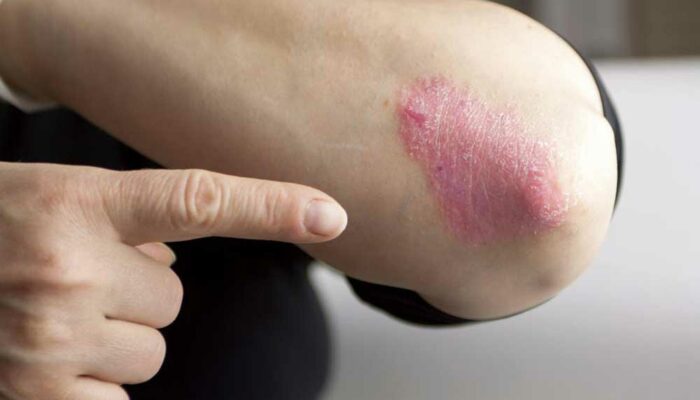 Home Remedies to Manage the Symptoms of Plaque Psoriasis