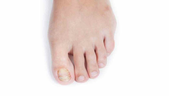 How to Treat Fungal Infections in the Toenails