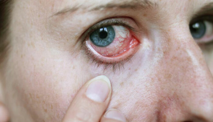 How to Treat Pink Eye with Eye Drops