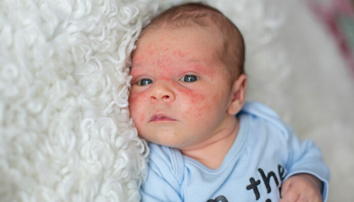 How Baby Eczema Differs With Age and Steroid Treatment