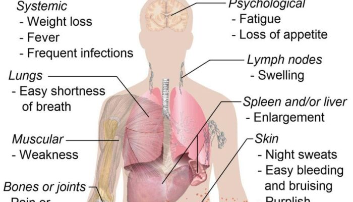 Is your Body Telling You About these Leukaemia Symptoms?