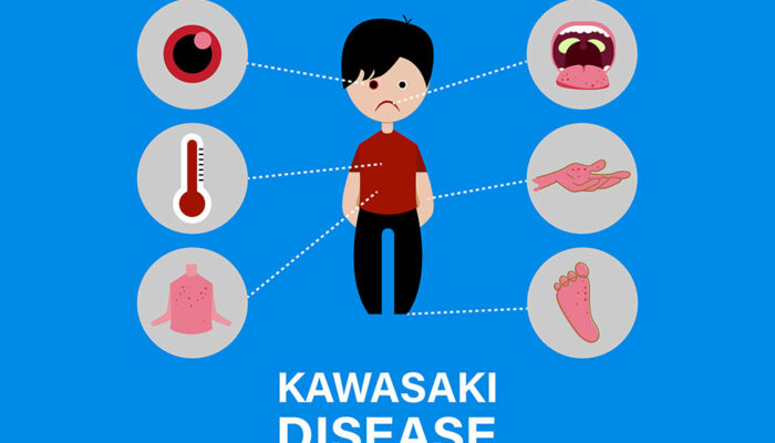 Kawasaki disease &#8211; causes and symptoms