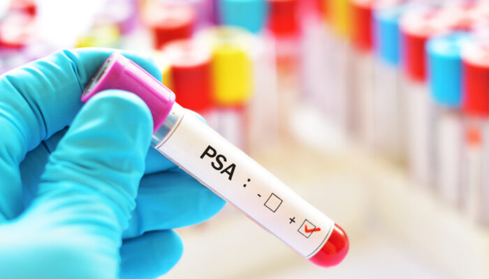 Know About Psa Levels And How To Lower Them