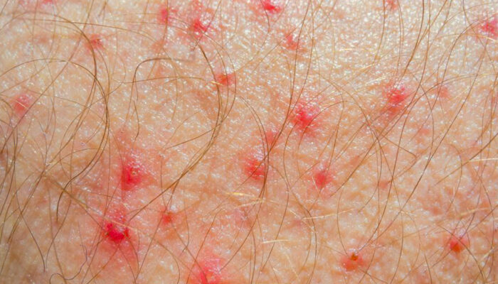 Know Everything about Atopic Dermatitis