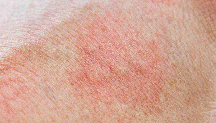 Know about the 5 Types of Skin Rashes