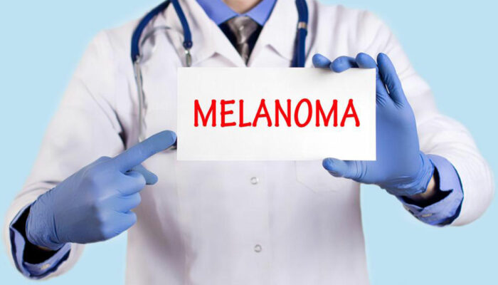 Know about the Diagnosis and Treatment Options for Metastatic Melanoma