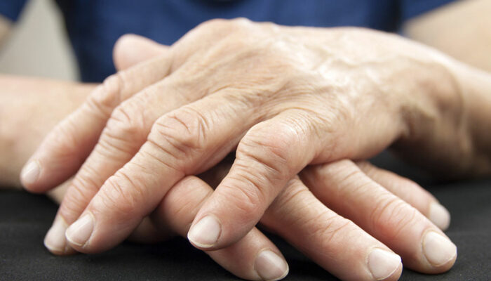 Know about the stages, diagnosis, and prevention of arthritis