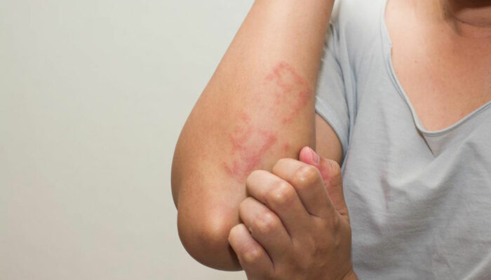 Lupus Skin Rash &#8211; Symptoms and Treatment