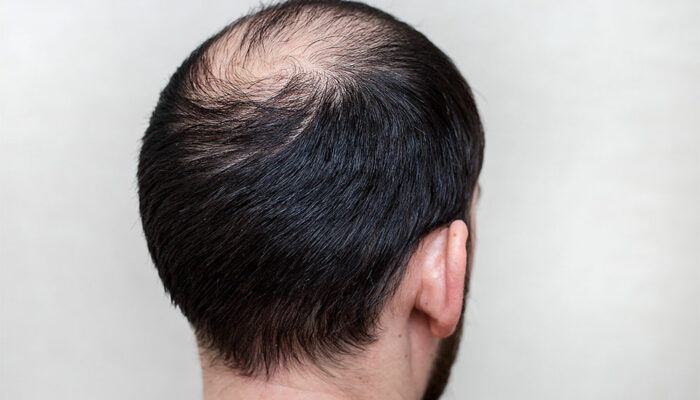 Male hair loss and its various aspects