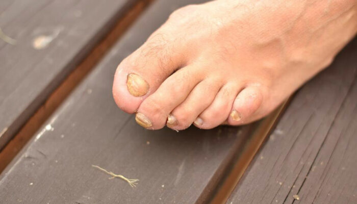 Most Beneficial Home Remedies for Toenail Fungus